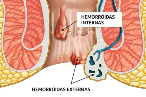 Exemplo de Hemorroidas.