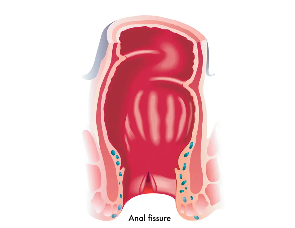 Imagem de fissura anal
