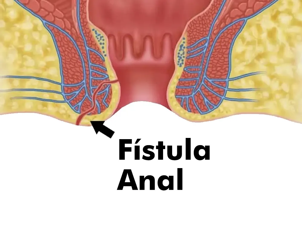 Desenho de Fístula Anal