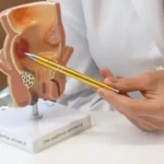 Dra. Sabryna mostra o que são Pólipos Intestinais